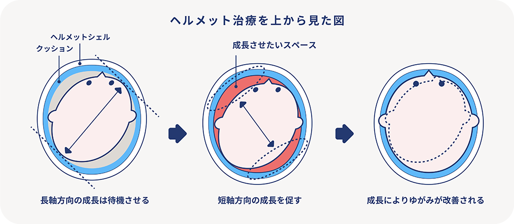 ヘルメット治療を上から見た図